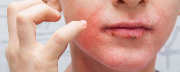 Traiter le psoriasis du visage