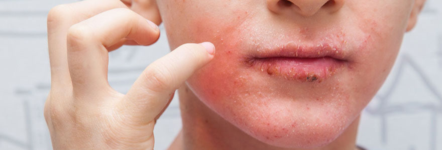 Traiter le psoriasis du visage
